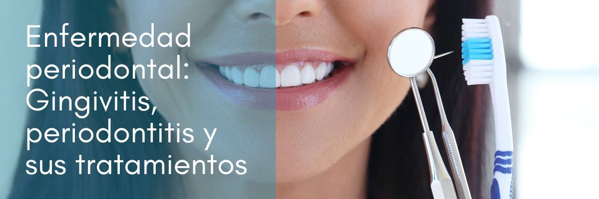 Periodontitis, gingivitis y piorrea enfermedades periodontales