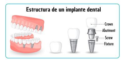 prótesis implantes dentales, tipos de implantes dentales, implantes dentales, implantes osteointegrados, implantes de dientes, cirugia dental implantes, implantes de carga inmediata ventajas y desventajas