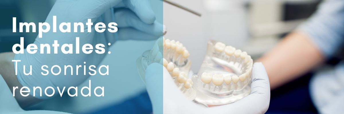 implantología dental en Clínica Doctores Arena. qué es, cuánto tarda el proceso, tipos de implantes