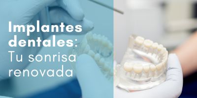implantes dentales clínica dental Doctores Arena