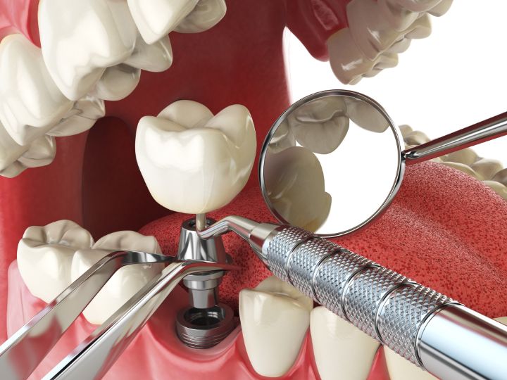 implantes dentales en Chamartín, clínica Dres. Arena. implantes dentales Clínica Doctores Arena en Chamartín