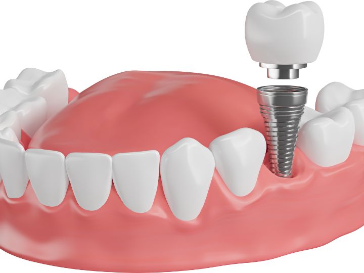 implantes dentales en Chamartín, clínica Dres. Arena