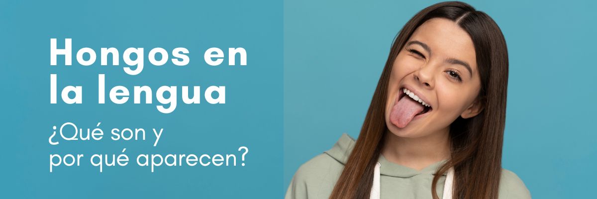 hongos en la lengua. Consulta con nosotros: Clínica dental Doctores Arena en Chamartín