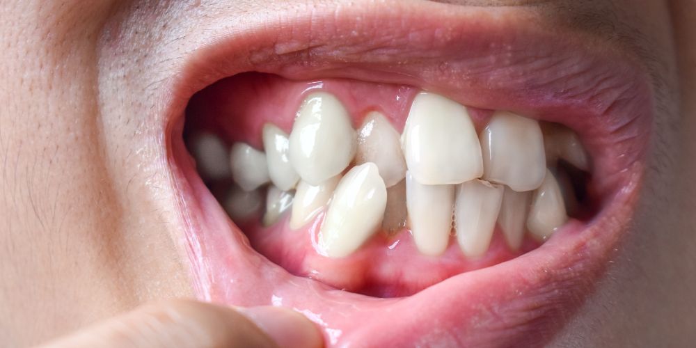 dientes torcidos, maloclusiones. Clínica Dres. Arena