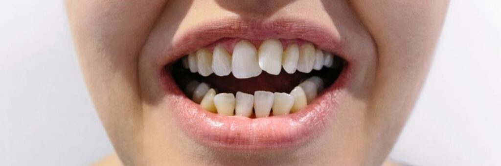 dientes torcidos. Clínica Dental Dres. Arena en Chamartín