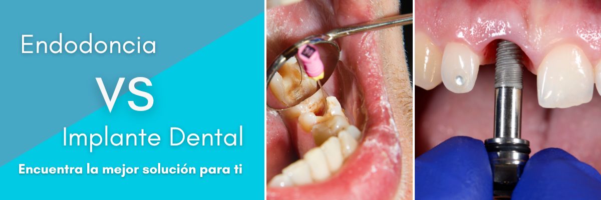 Endodoncia vs Implante Dental: Encuentra la mejor solución para ti