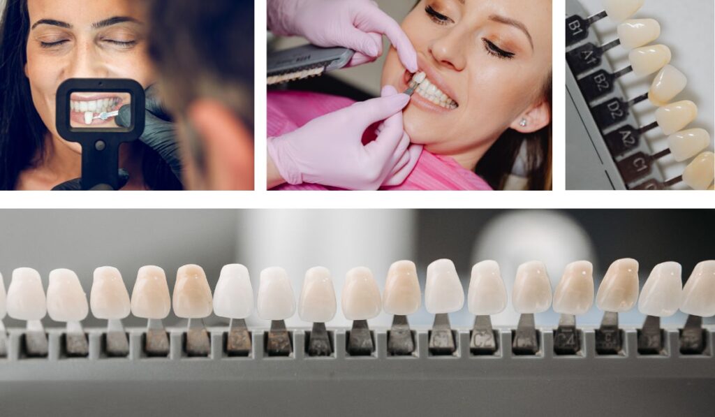 carillas dentales en Chamartín. Clínica dental Dres. Arena