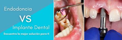 endodoncia vs implantes dentales. clínica dental Dres. Arena enChamartín