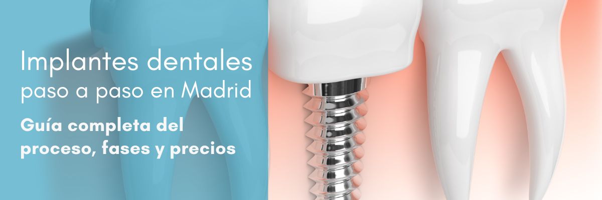 implantes dentales paso a paso en Madrid (1)