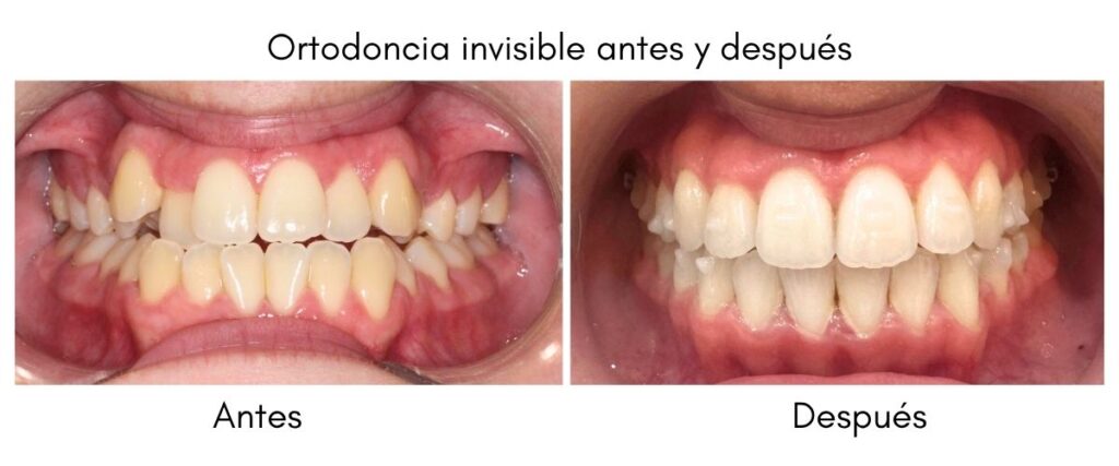 Ortodoncia invisible antes y después Clínica dental Doctores Arena en Chamartín, Madrid