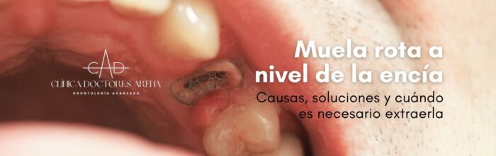 Muela rota a nivel de encía: 【Causas y soluciones】