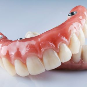 pRÓTESIS DENTALES EN CHAMARTÍN - Clínica dental Dres. Arena en Chamartín, Madrid