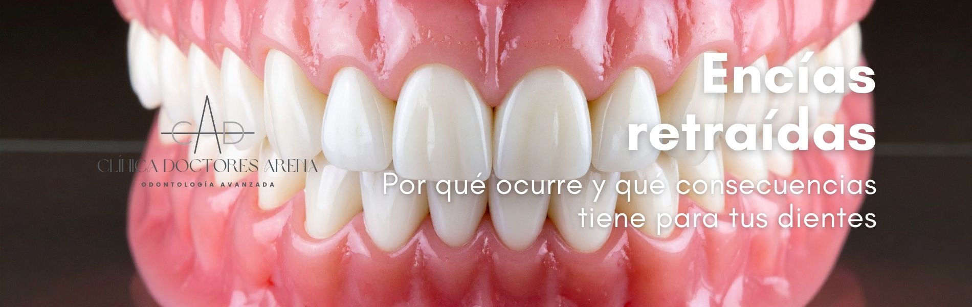 ENCÍAS retraídas por qué ocurre y qué consecuencias tiene para tus dientes - Dres .Arena dentistas de confianza en Chamartín
