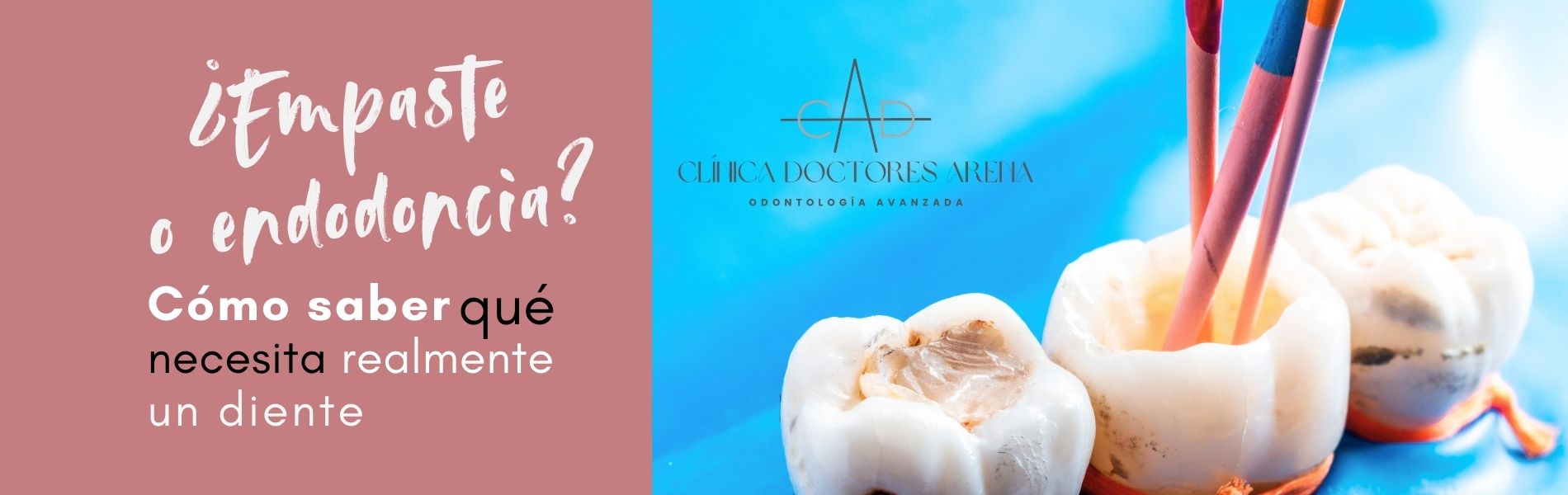 Empaste dental o endodoncia?