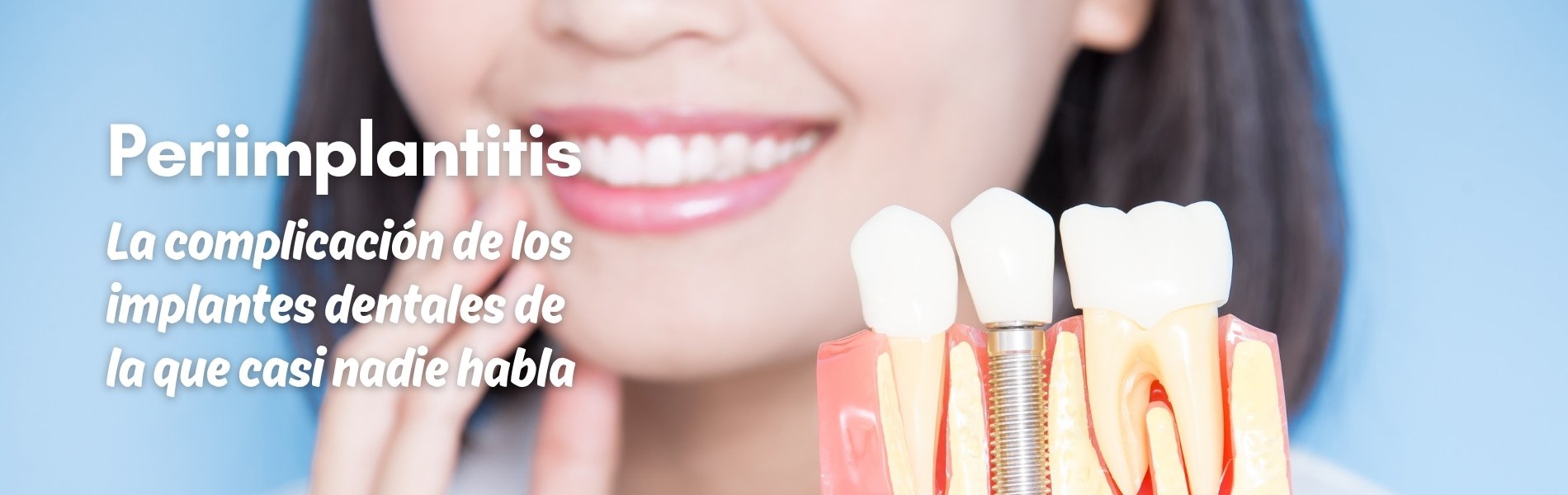 Perimplantitis la complicación de los implantes dentales de la que casi nadie habla - Dres .Arena dentistas de confianza en Chamartín