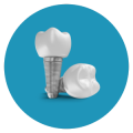implantes dentales en Chamartín, clínica Dres. Arena
