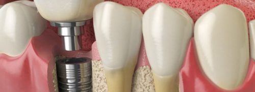 cirugía bucal. Somos especialistas en implantología dental en nuestra clínica dental Doctores Arena